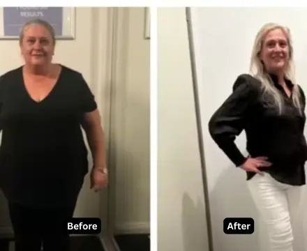 Tirzepatide-Before-After2